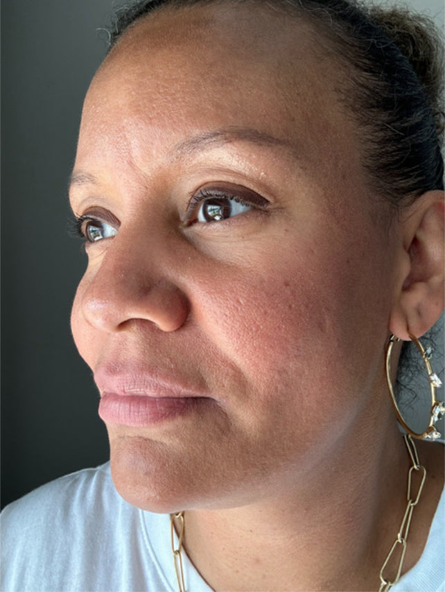 ASHLEY C before using lip balm. Lips appear dry and cracked.